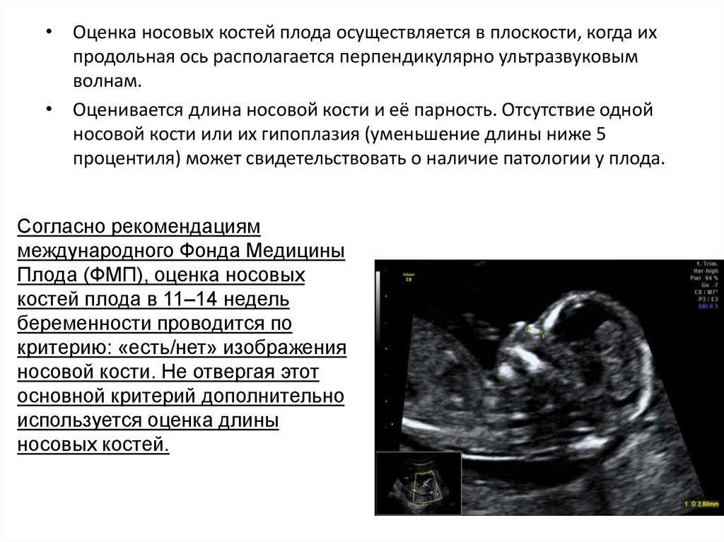 Длина костей. УЗИ плода 1 триместр носовая кость. Измерение носовой кости у плода на УЗИ. УЗИ носовой кости плода на 12 неделе беременности. УЗИ 13 недель беременности носовая кость.