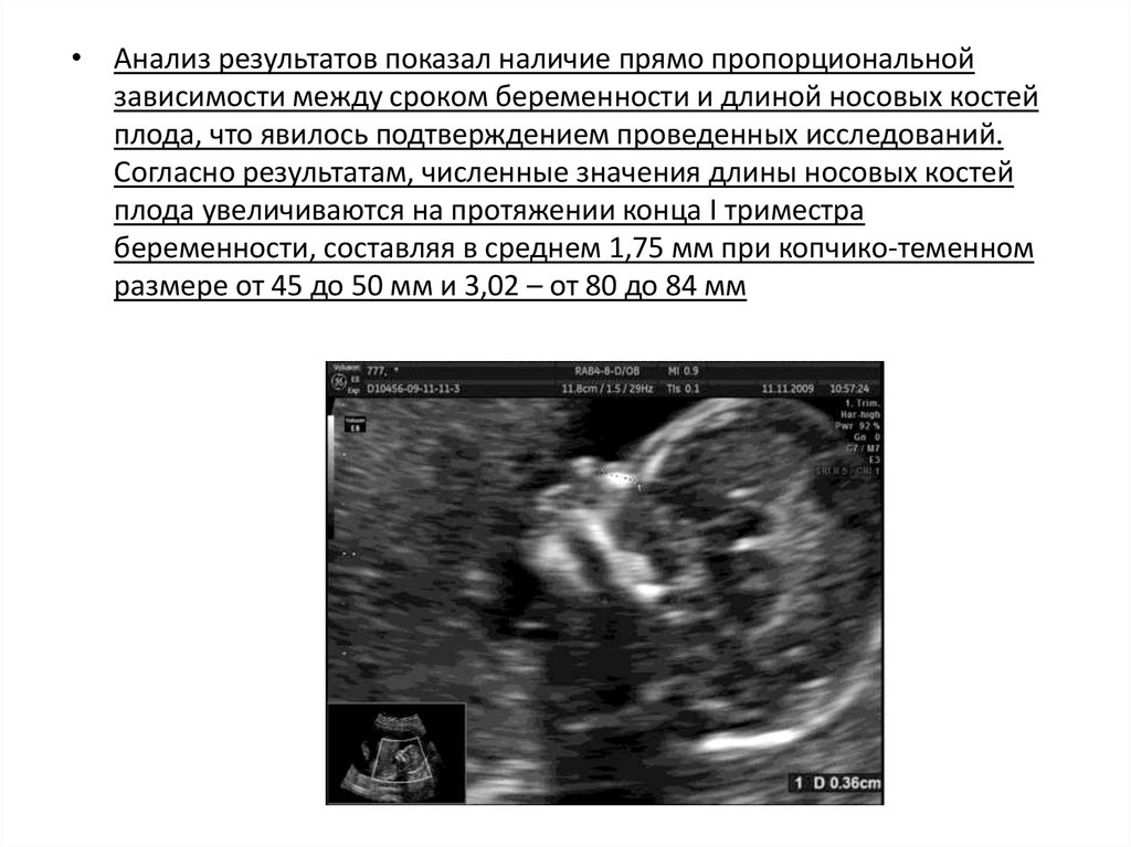 Длина костей. Носовая кость 1 триместр. Длина носовых костей плода. Скрининг 1 триместра носовая кость.