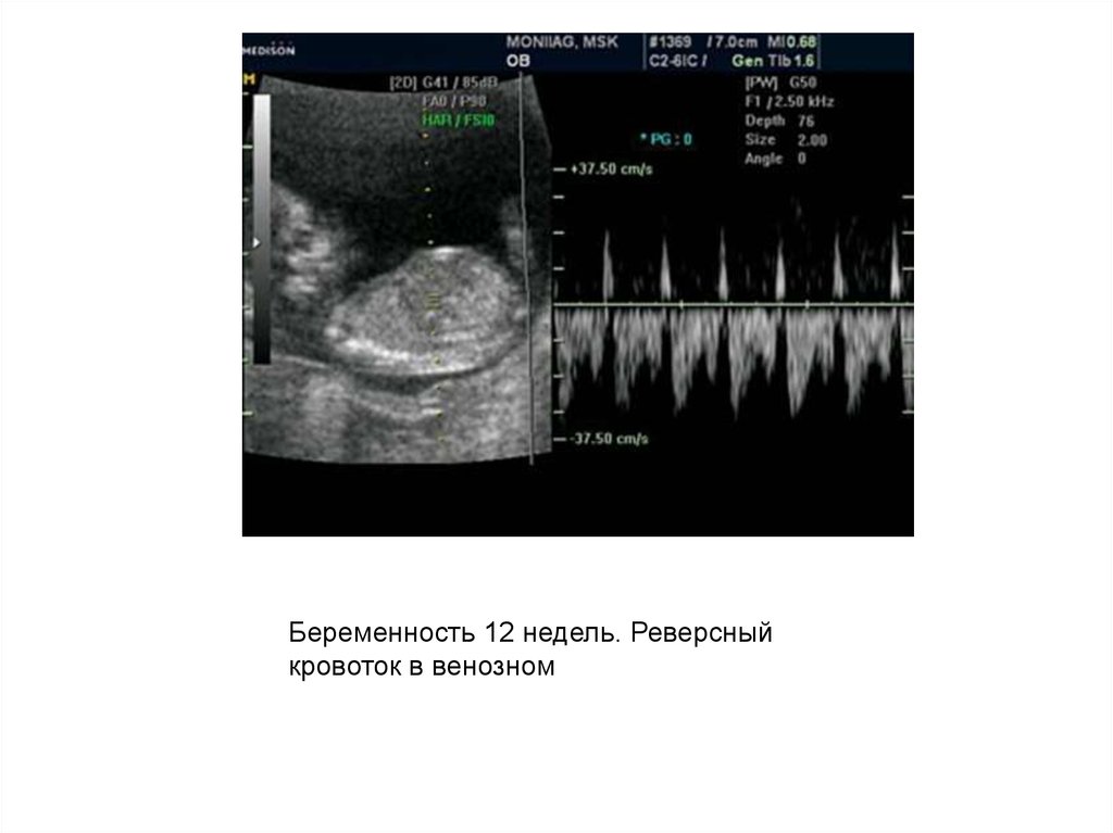 Нормы венозного протока pi. Кровоток в венозном протоке Pi норма 13 недель. Венозный кровоток у плода в 12 недель. Кровоток в венозном протоке 12 неделям беременности. Кровоток в венозном протоке 12 недель норма Pi.