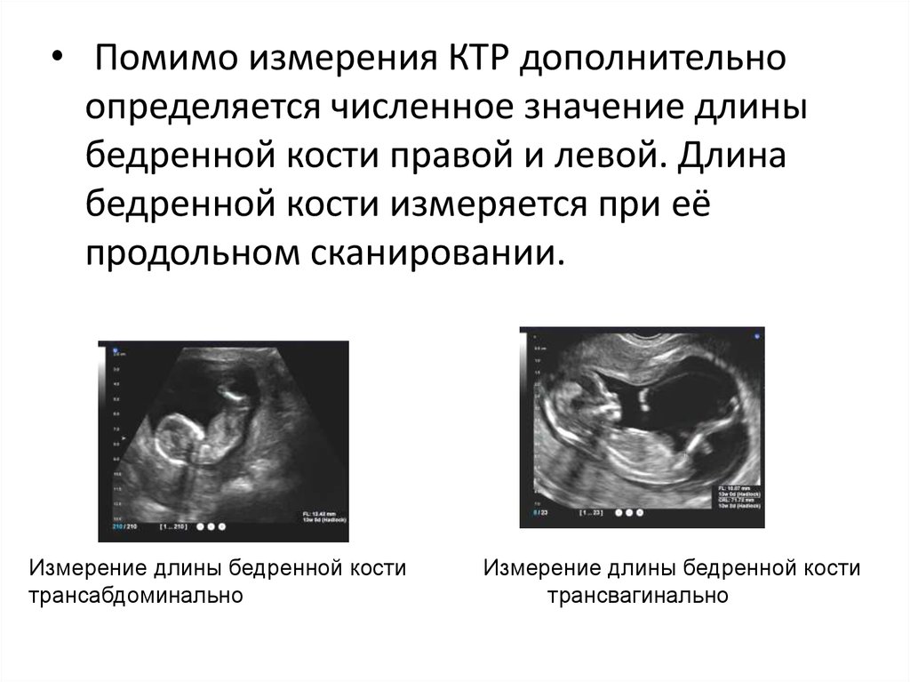 Скрининг на 12 неделе беременности