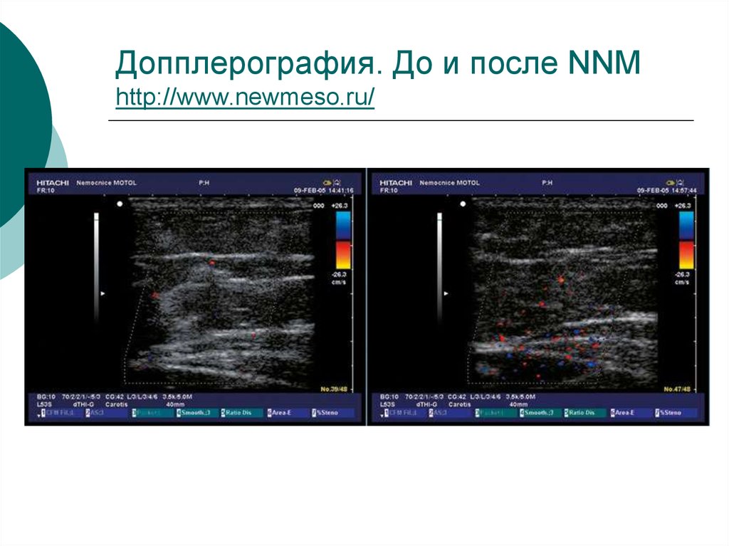 Допплерография это. Допплерография. Непрерывная допплерография. Лазерная допплерография. Допплерография молочных желез.