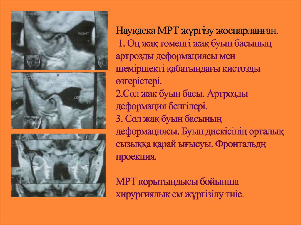 Буын синдромы презентация