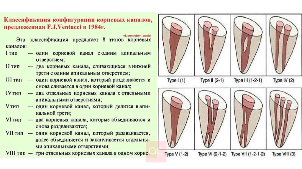 Методы лечения зубов с проблемными корневыми каналами презентация