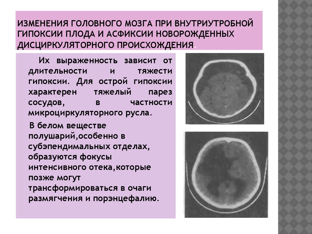 Изменения головного мозга у новорожденного. Порэнцефалия головного мозга. Гипоксическое повреждение головного мозга. Реакция мозга на гипоксию. Кратковременная гипоксия головного мозга.