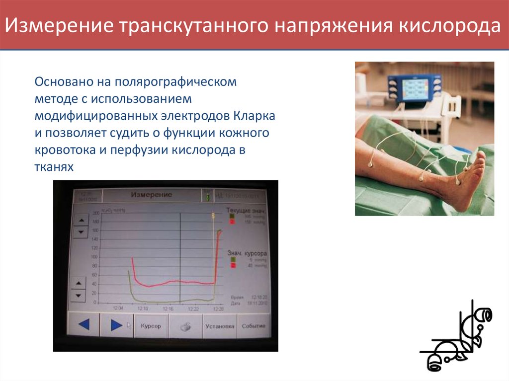 Напряжение кислорода. Транскутанная оксиметрия. Измерение транскутанного напряжения кислорода. Транскутанное напряжение кислорода. Чрескожное измерение напряжения кислорода.