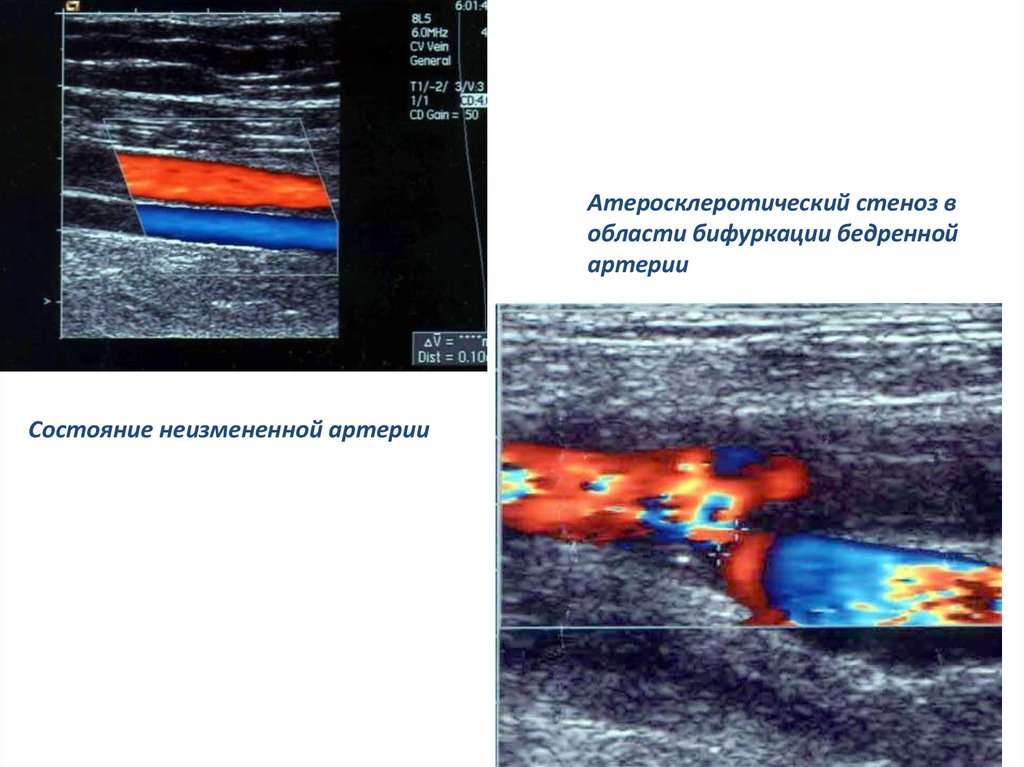 Стадии облитерирующего атеросклероза. Бифуркация бедренной артерии. Стеноз бедренной артерии. Кальцинированная атеросклеротическая бляшка. Кальцинированные бляшки в коронарных артериях.
