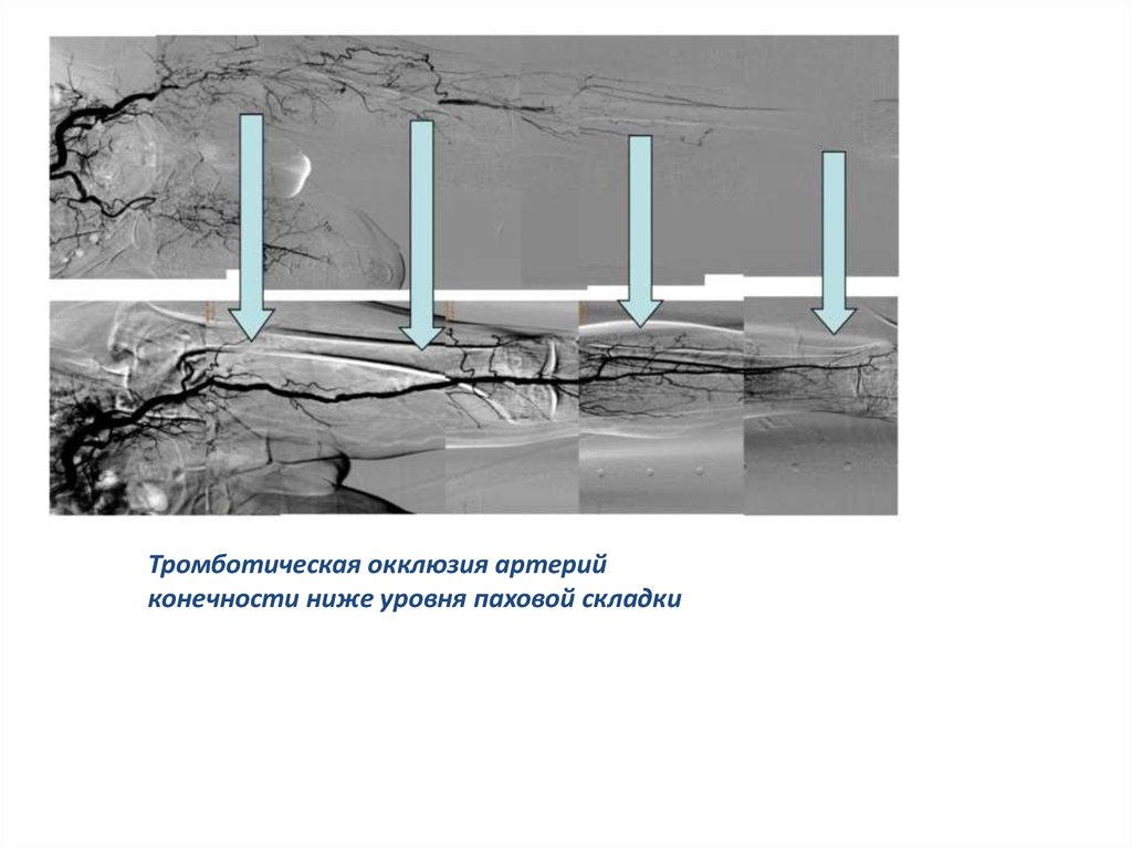 Окклюзия сосудов конечностей. Тромботическая окклюзия. Окклюзия окружающей среды. Тромботическая окклюзия ПНА.