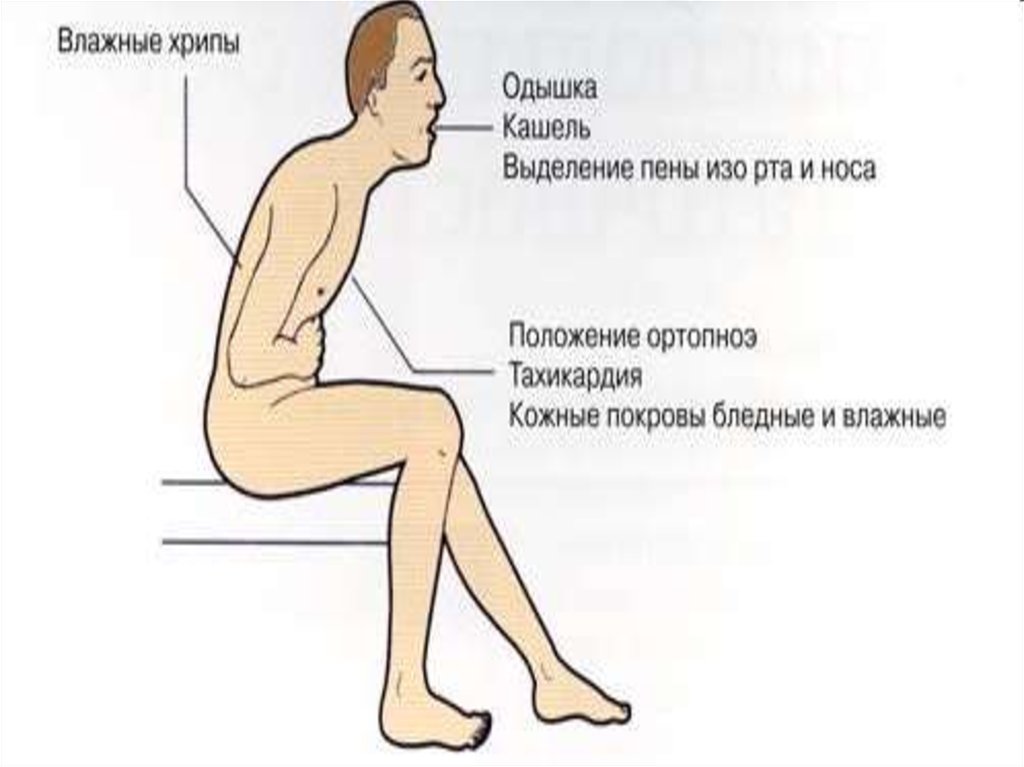 Ортопноэ. Положение при ортопноэ. Вынужденное положение ортопноэ. Вынужденное положение при хронической сердечной недостаточности. Положение ортопноэ при бронхиальной.