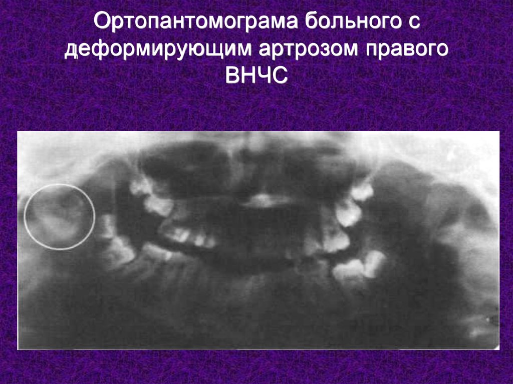 Рентгенологическая картина костного анкилоза внчс характеризуется