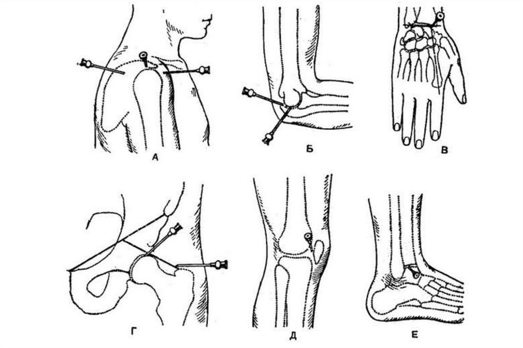 Укол в голеностопный сустав. Пункция локтевого сустава схема. Точки пункции коленного сустава топографическая анатомия. Пункция локтевого сустава точки пункции. Пункция тазобедренного сустава техника.