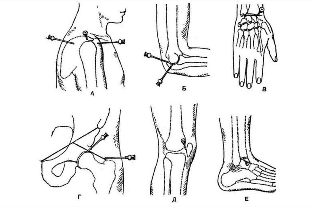 Пункция коленного сустава. Точки для пункции плечевого локтевого лучезапястного. Пункция плечевого сустава схема. Точки пункции тазобедренного сустава. Пункция тазобедренного сустава точки пункции.