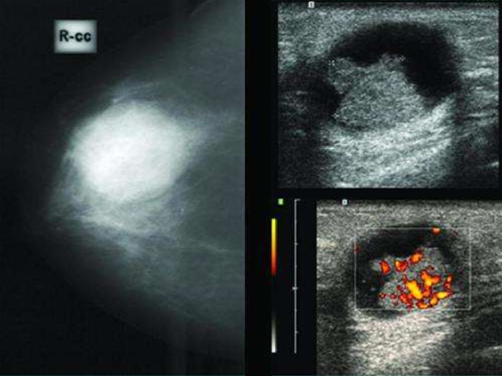 Киста молочной. Внутрипротоковая карцинома УЗИ. Раковая киста молочной железы. Киста молочной железы на УЗИ.