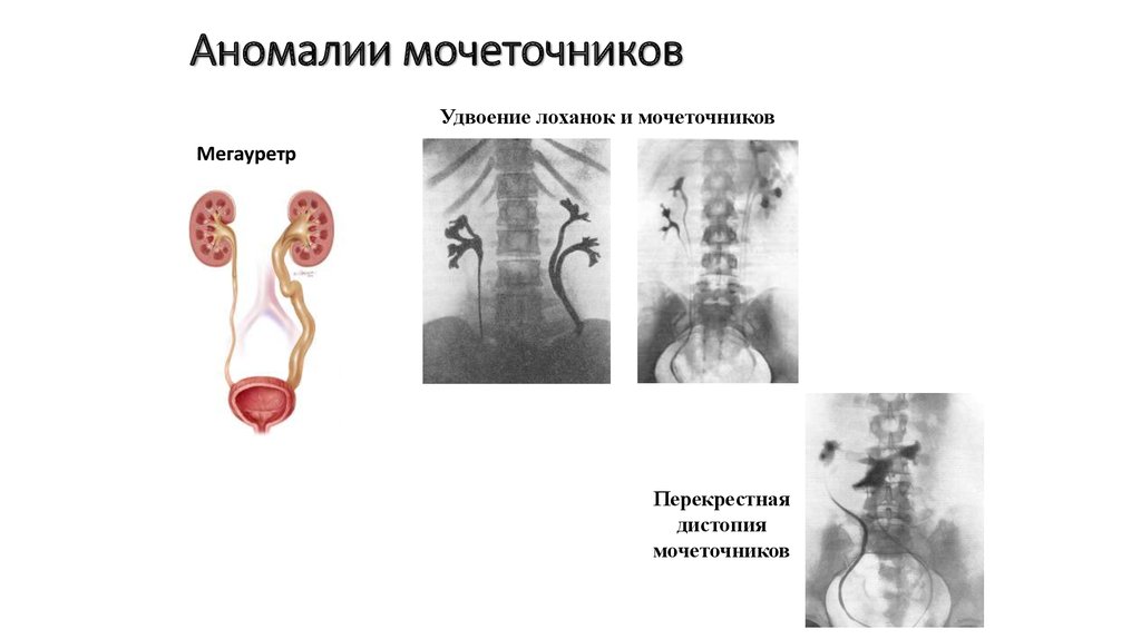 Развитие мочеточников. Аномалии развития почек и мочеточников. Аномалии развития лоханок почек. Врожденные аномалии мочеточников. Врожденные аномалии мочеточника у детей.