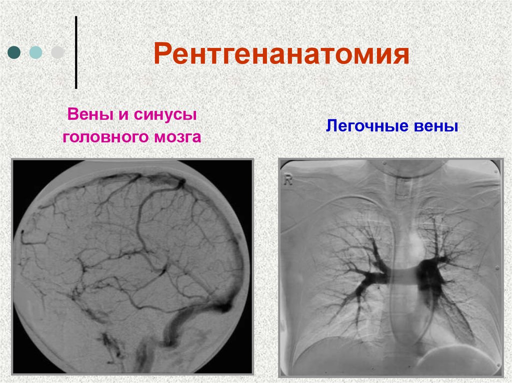 Гипоплазия синусов головного. Аномалия развития синусов. Тромбоз венозного синуса головного мозга мкб. Синусы головного мозга кт. Жировые образования в венозных синусах головы.