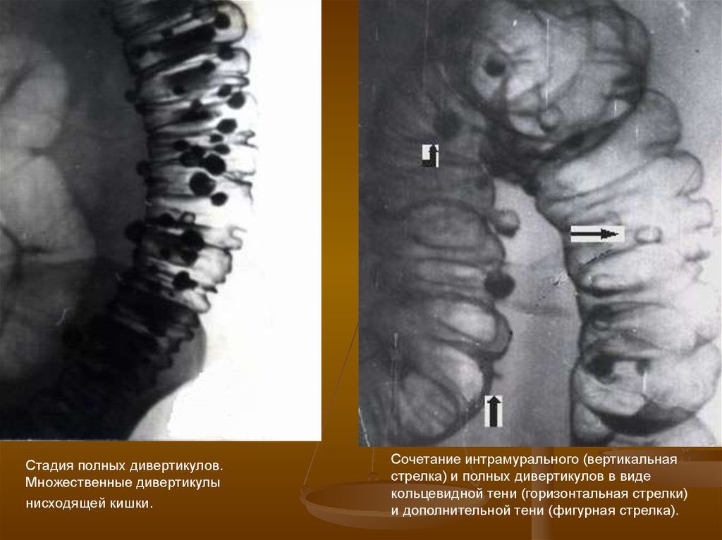 Дивертикулы сигмовидной кишки фото