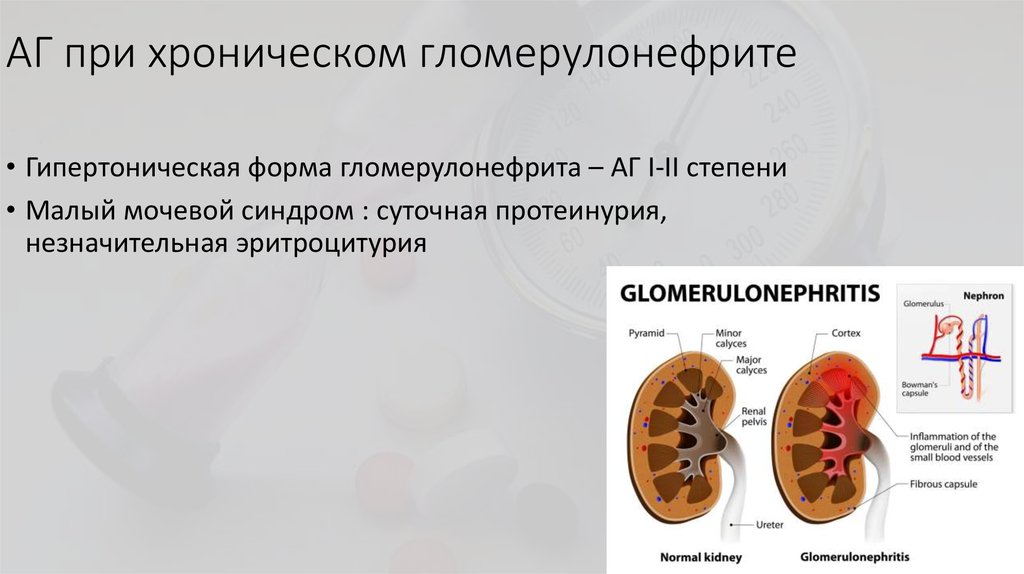 Острый гломерулонефрит триада. Острый и хронический гломерулонефрит. Болезни и патологии почек.