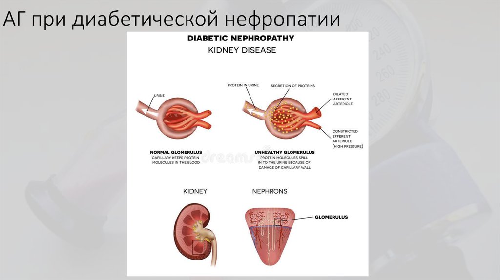 Диабетическая нефропатия картинки