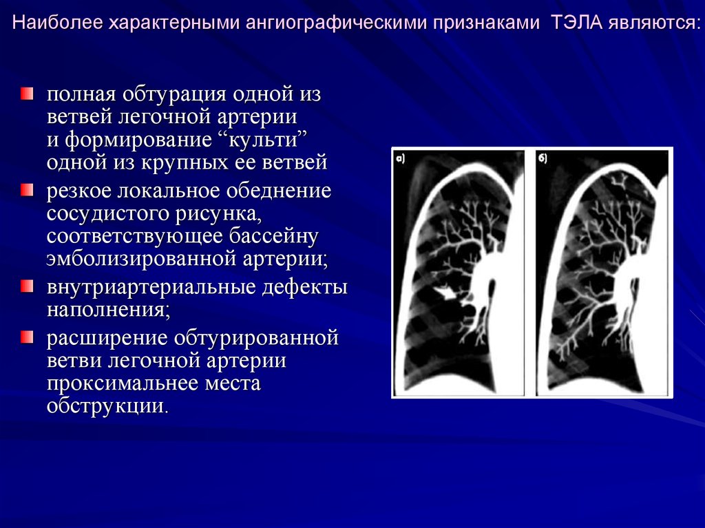 Обеднение сосудистого рисунка легких характерно для