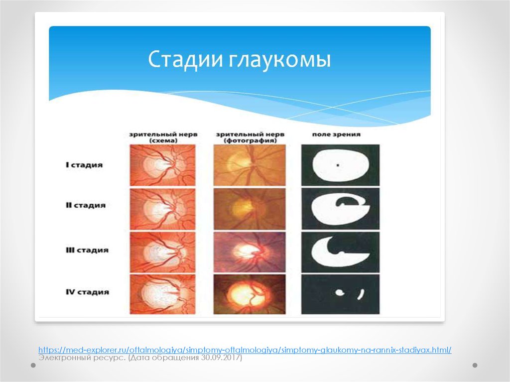 Классификация глаукомы. Открытоугольная глаукома этиология. Терминальной стадии первичной глаукомы. Первичная открытоугольная глаукома развитой стадии. Глаукома открытоугольная по стадиям.