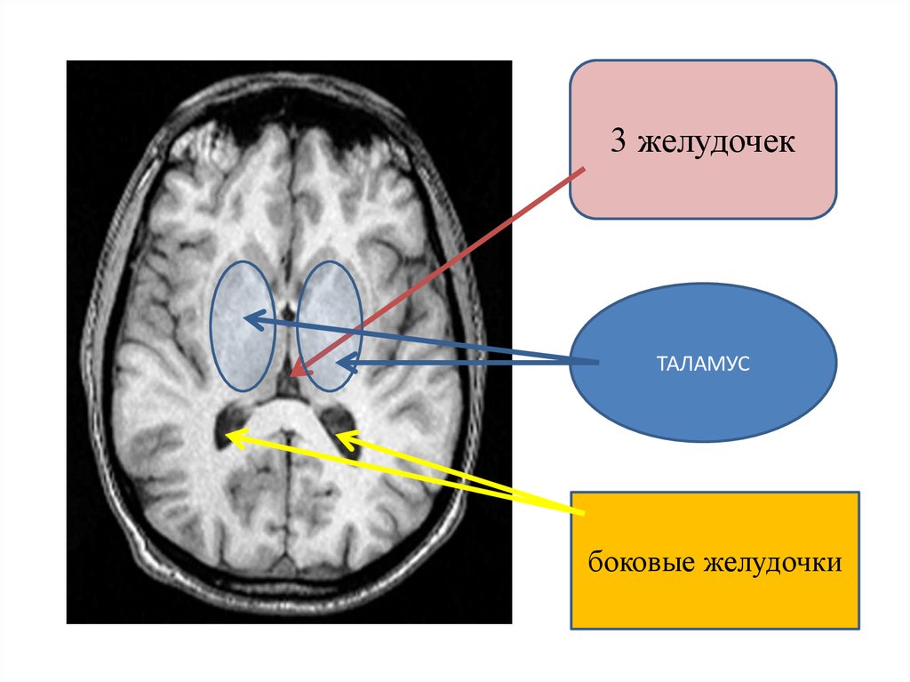 3 желудочек. Желудочки головного мозга кт анатомия. 3 Желудочек головного мозга кт. Строение боковых желудочков головного мозга на мрт. Боковые желудочки головного мозга кт.