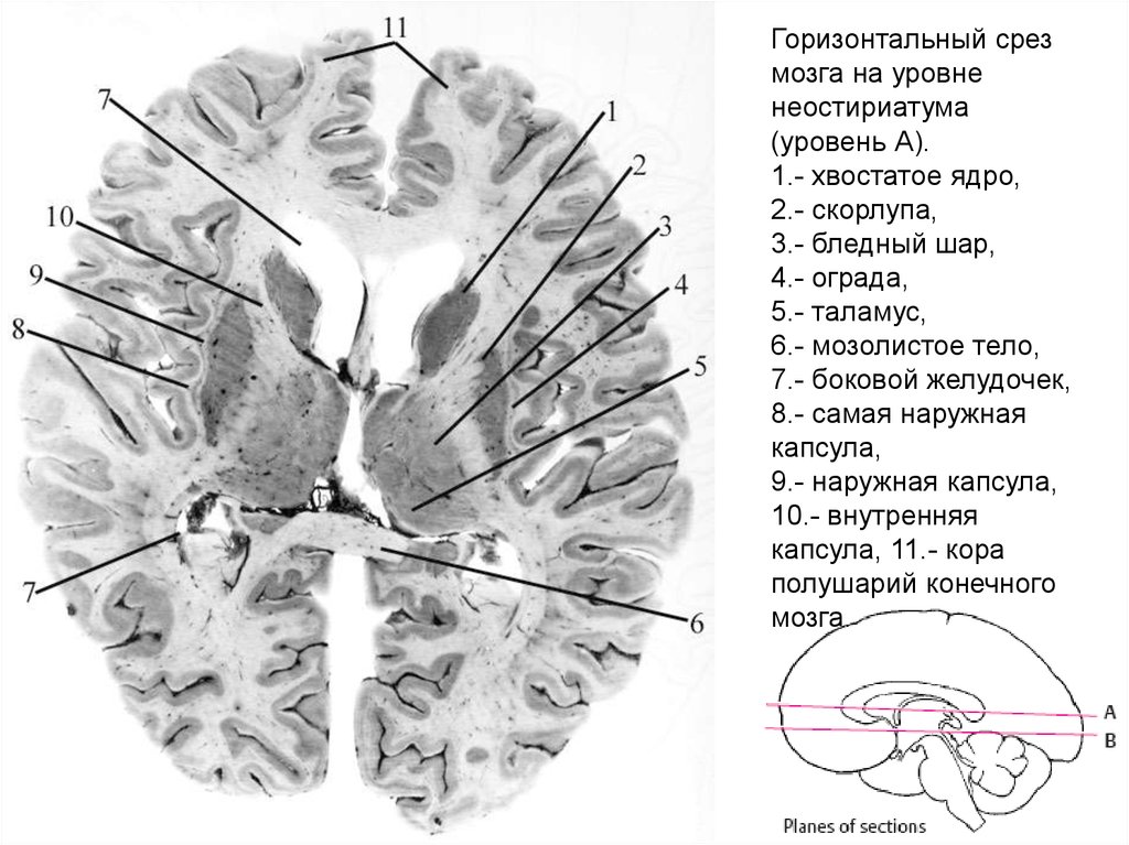 Ядра мозга образованный. Мозолистое тело фронтальный срез. Горизонтальный срез головного мозга базальные ядра. Поперечный срез головного мозга мозга. Поперечный срез головного мозга схема.