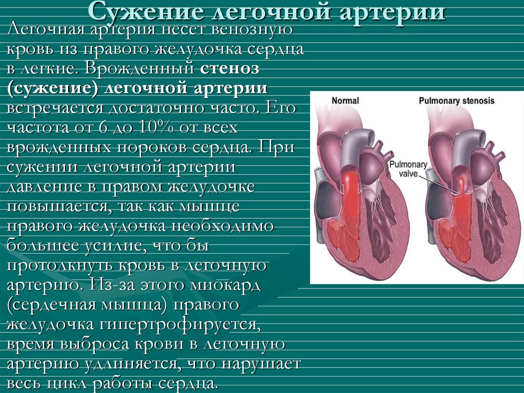 Легочная артерия картинка