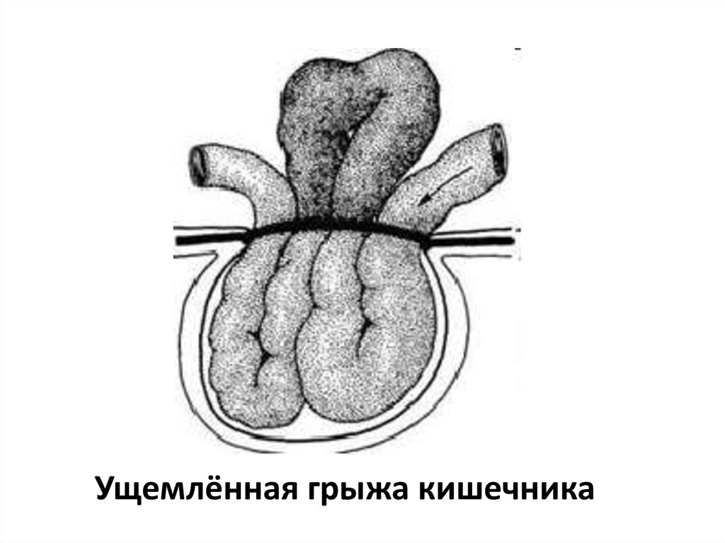 Ущемленная грыжа. Ретроградное ущемление тонкой кишки. Ущемленная грыжа этиология. Антеградное ущемление грыжи. Ретроградное ущемление петли кишки.