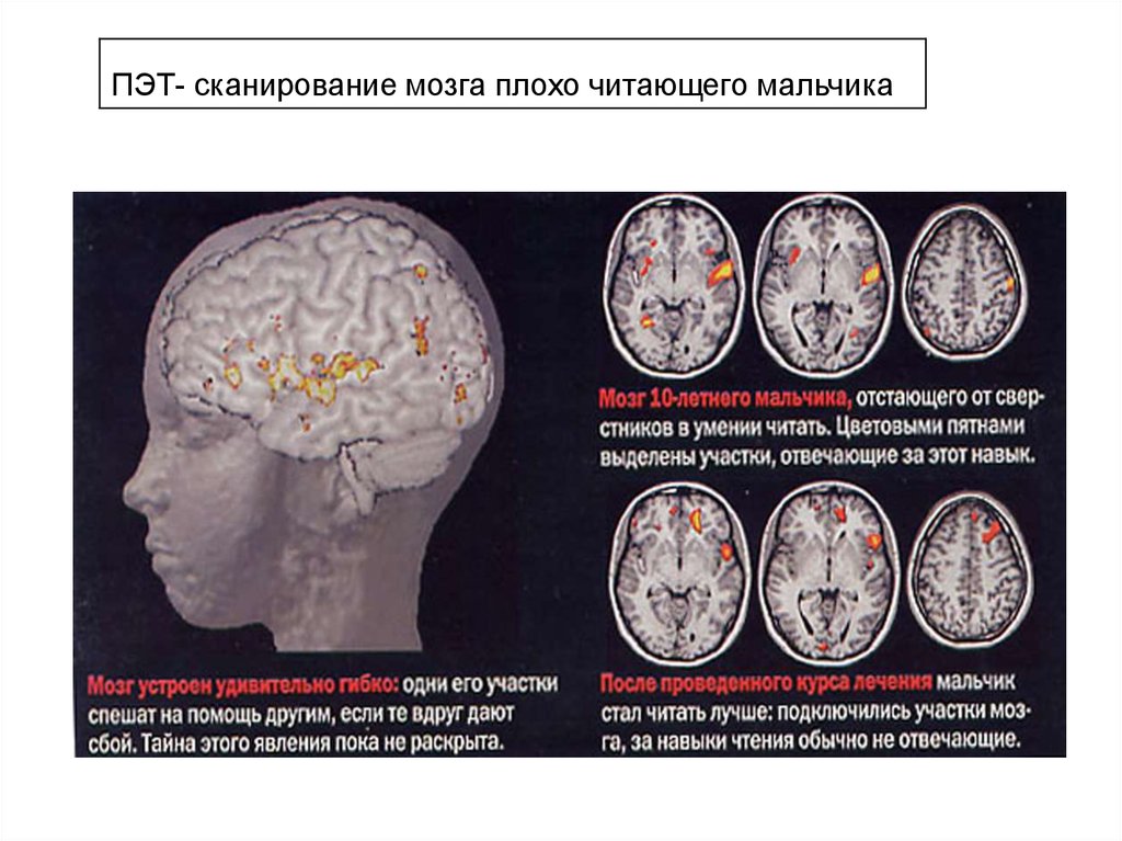 Плохое мозга. ПЭТ сканирование мозга. Сканограмма мозга. Метод проверки мозга. Окр мозг.