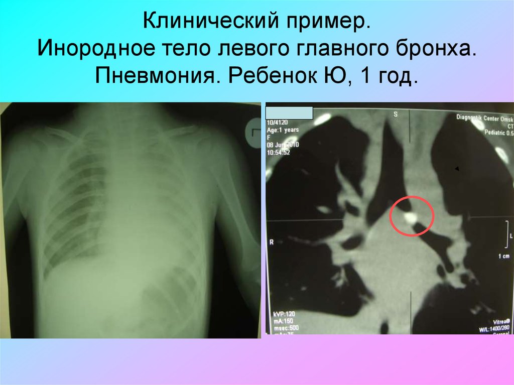 Инородные тела дыхательных путей причины