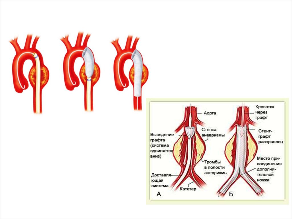 Аневризмы аорты презентация