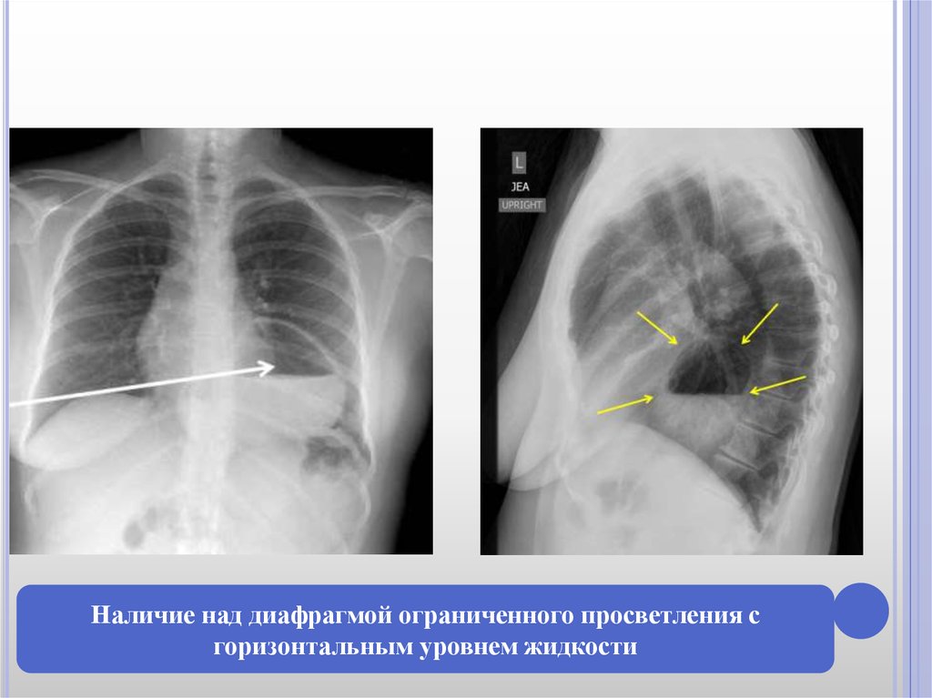 Горизонтальные уровни жидкости. Горизонтальный уровень жидкости на рентгене. Грыжа пищеводного отверстия диафрагмы. Диафрагмальная грыжа на кт.