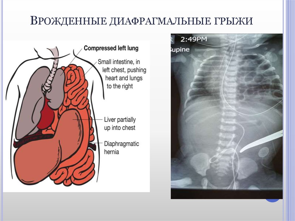 Диафрагмальные грыжи презентация хирургия