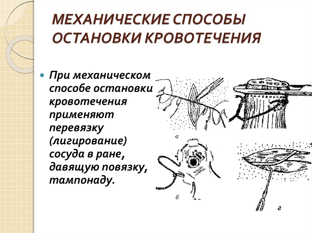 Механический способ. Механические методы остановки кровотечения. Механический метод остановки кровотечения. Механические методы окончательной остановки кровотечения. Механические способы остановки кровотечения.