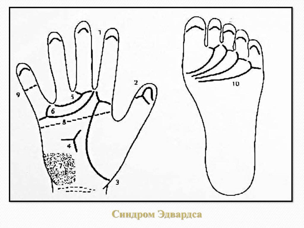 Синдром Эдвардса