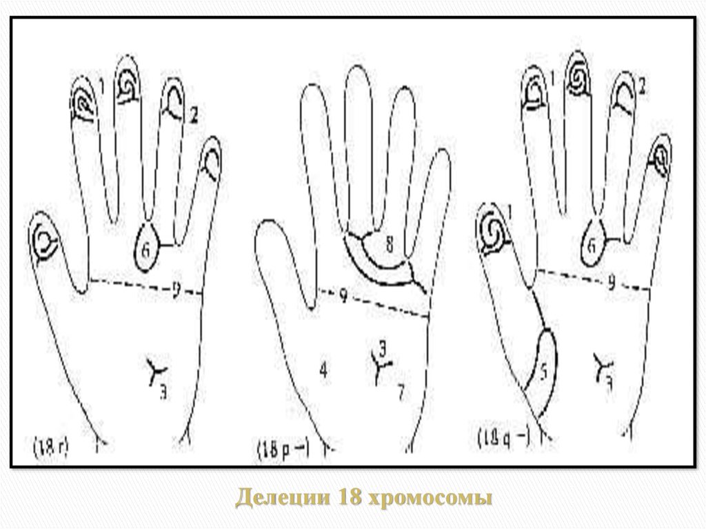 Делеции 18 хромосомы