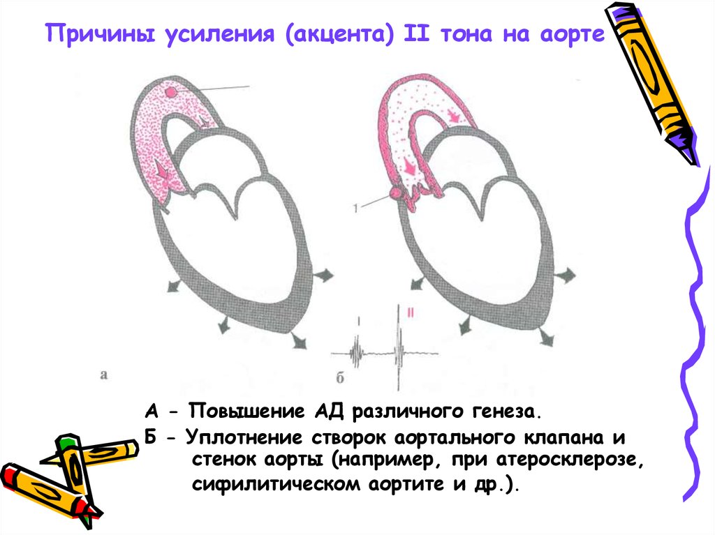 Акцент тона. Акцент 2 тона над аортой схема. Акцент 2 тона над легочной аортой. Акцент 2 тона на аорте выслушивается. Акцент второго тона на легочной артерии.