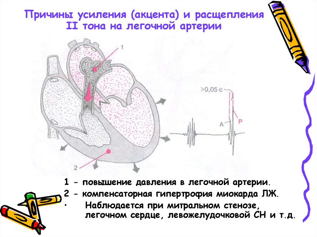 Причины усиления (акцента) и расщепления II тона на легочной артерии