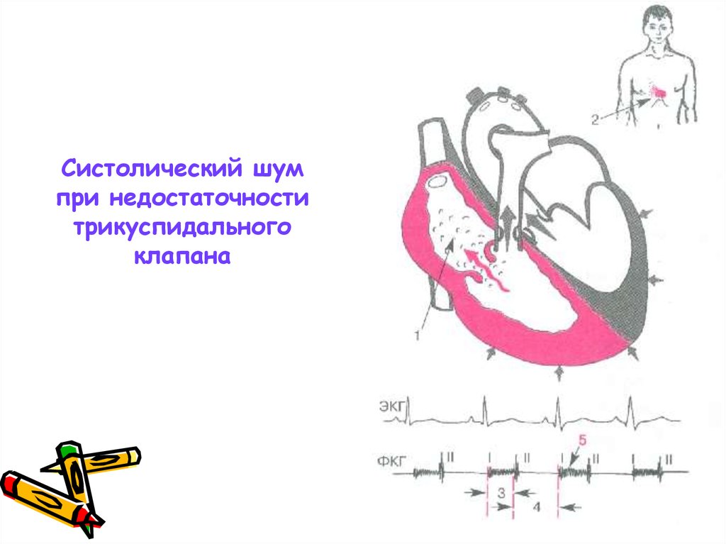 Трикуспидальная недостаточность презентация