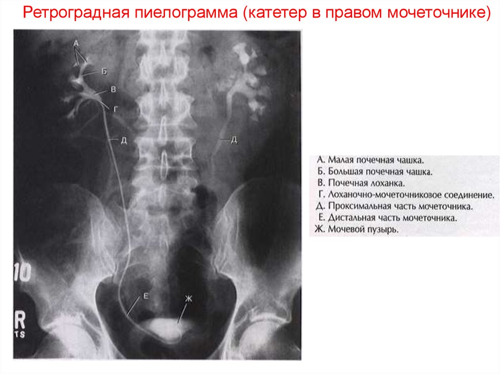 Устье мочеточника фото