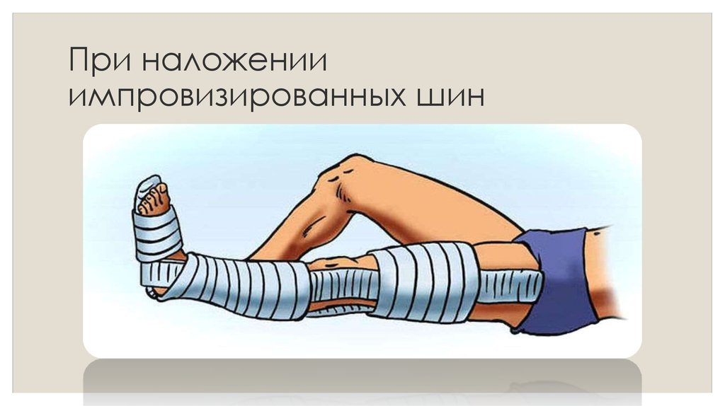 Наложение шины. Импровизированные шины при переломах. При наложении шины. При переломе костей голени шина накладывается. При переломе костей голени шину накладывают от.