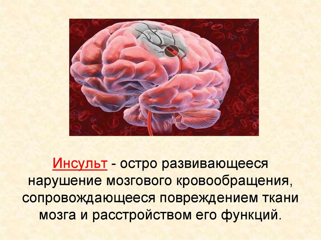 Нарушение мозгового кровообращения презентация