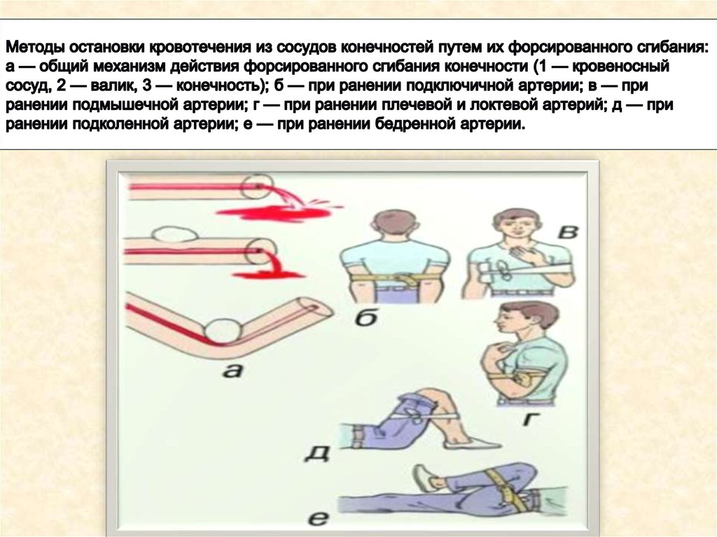 Способы остановки кровотечений тест. Способы остановки кровотечений из артерий. Остановка кровотечения из сосуда. Способ остановки кровотечения конечности. Метод остановки кровотечения путем сгибания конечности.