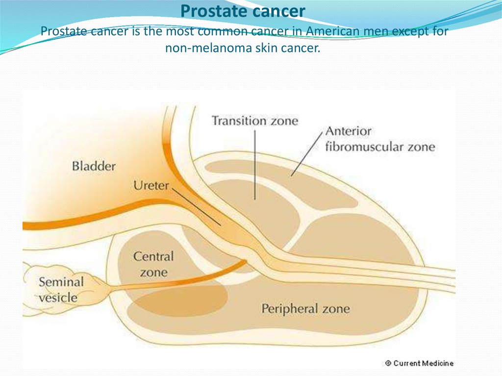 Prostate cancer Prostate cancer is the most common cancer in American men except for non-melanoma skin cancer.