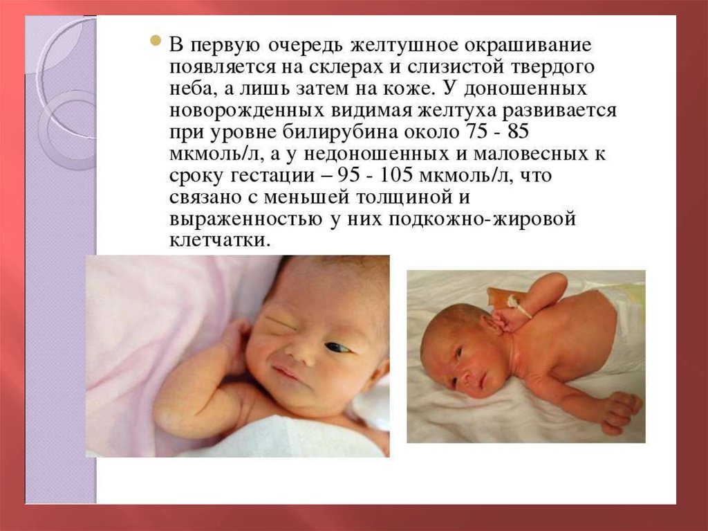 Почему новорожденный стал. Причины физиологической желтухи новорожденных. Легкая желтушка у новорожденных 1 месяц. Как определяется желтушка у новорожденного. Остаточная желтушка у новорожденных.