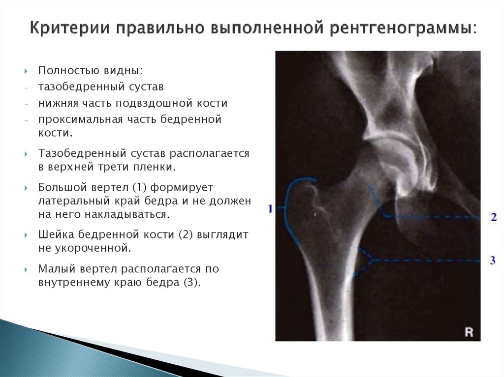 Тендинит тазобедренного сустава симптомы и лечение