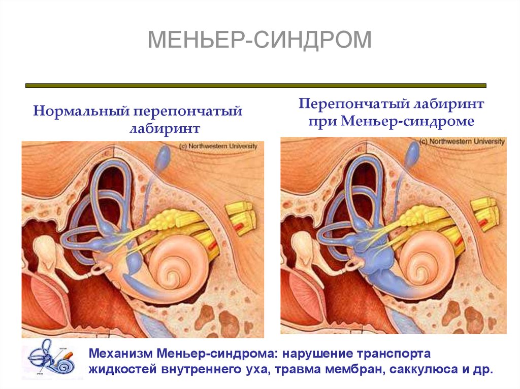 Синдром миньера что это. Болезнь Меньера гидропс. Барабанная перепонка при болезни Меньера. Снижения слуха при болезни Меньера.