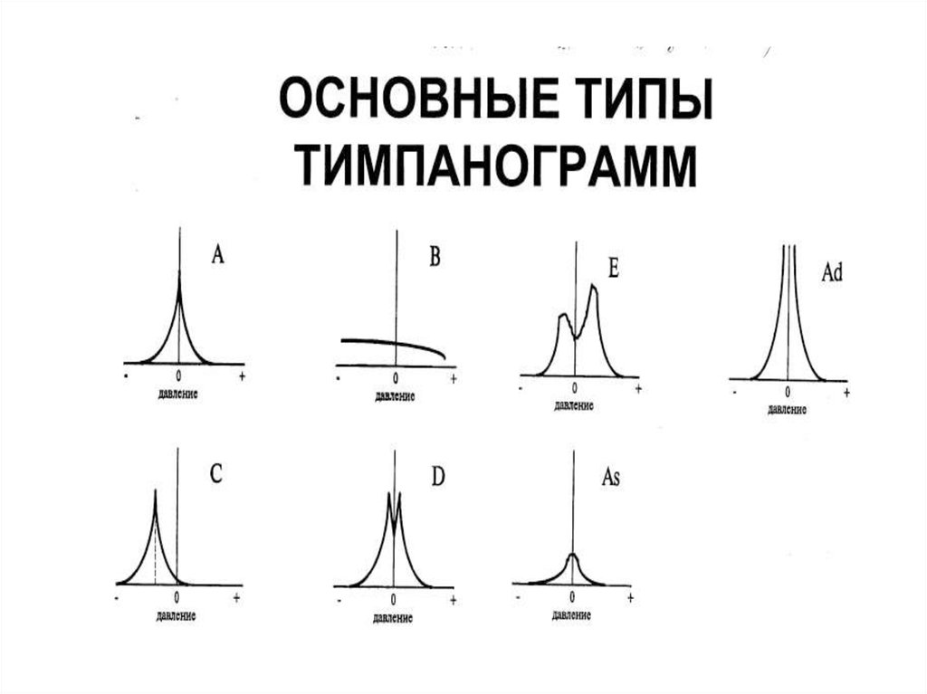 Типы тимпанограмм