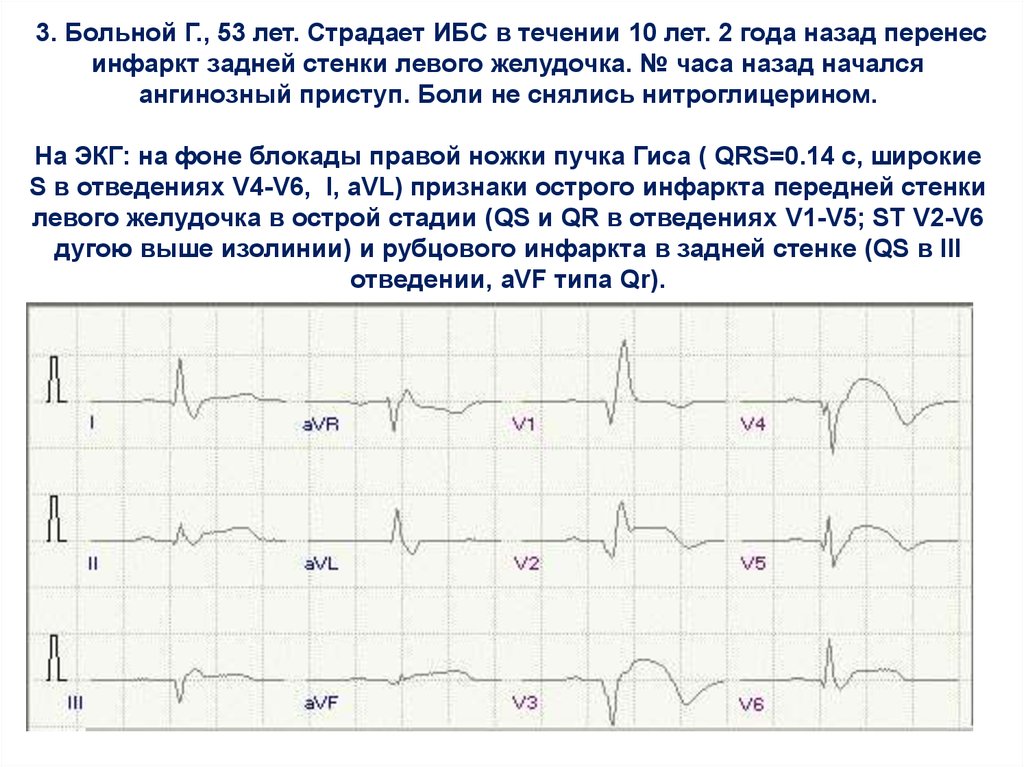 Очаговые изменения на экг. Инфаркт миокарда левого желудочка ЭКГ. ЭКГ при диффузных изменениях миокарда. ЭКГ критерии инфаркта правого желудочка. Инфаркт миокарда передней перегородки на ЭКГ.