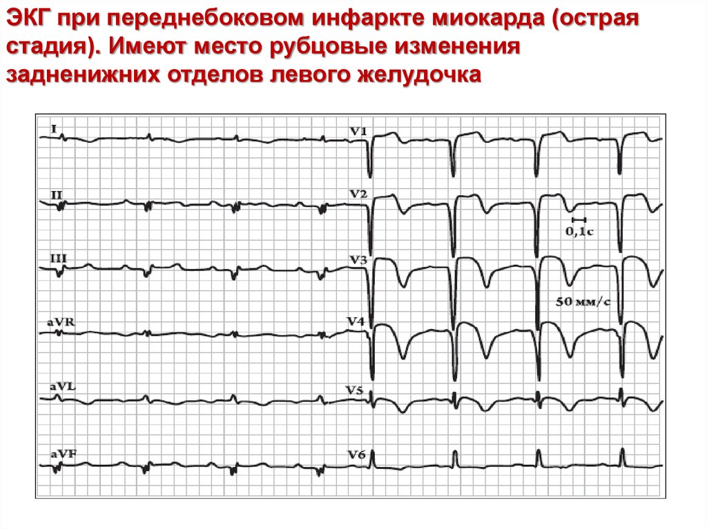 Передний боковой инфаркт миокарда