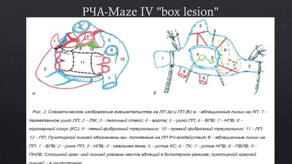 РЧА-Maze IV "box lesion"